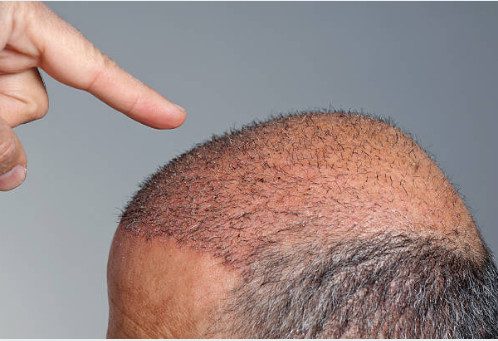 “Ponovno Sticanje Samopouzdanja: Transplatacija Kose kao Revolucionarni Korak u Lečenju Gubitka Kose”